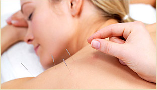 Acupuncture